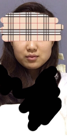 在郑州打的注射瘦脸注射瘦脸