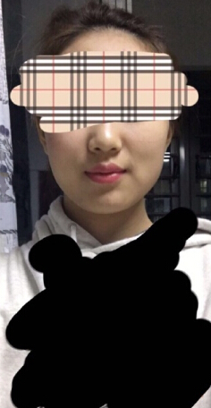 在郑州打的注射瘦脸注射瘦脸