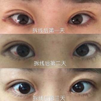 上海华山医院杨君毅医生手术案例