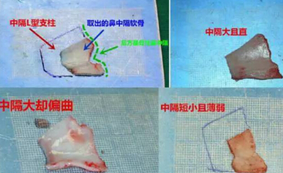 鼻整形用鼻中隔软骨没问题吗？