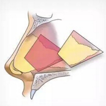 鼻整形用鼻中隔软骨没问题吗？