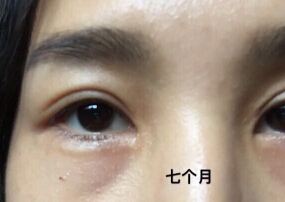 济南美容整形医院陈晓飞院长手术案例