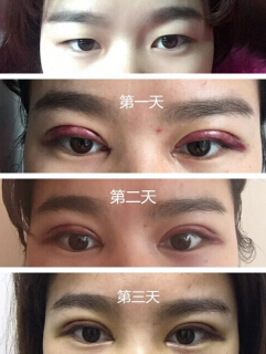 杭州优医联合医美周其光院长技术怎么样?