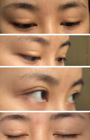 做完微创双眼皮手术,现在有三年多了