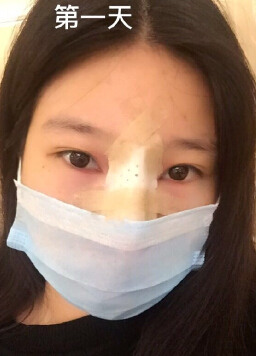 南宁美丽焦点整形焦俊光医生做的鼻部手术