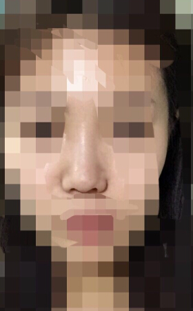 韩国TL整形做的鼻中隔鼻部手术整形手术案例