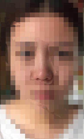 韩国TL整形做的鼻中隔鼻部手术整形手术案例