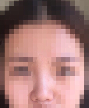 韩国TL整形做的鼻中隔鼻部手术整形手术案例