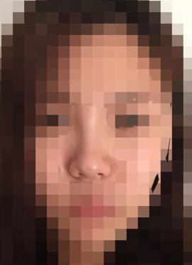 韩国TL整形做的鼻中隔鼻部手术整形手术案例