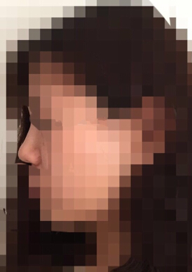 韩国TL整形做的鼻中隔鼻部手术整形手术案例