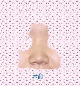 九院陈付国医生做的肋软骨鼻部手术整形手术