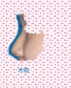 九院陈付国医生做的肋软骨鼻部手术整形手术