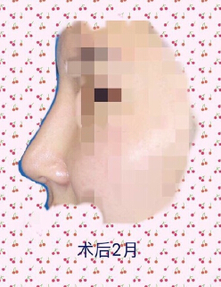 九院陈付国医生做的肋软骨鼻部手术整形手术