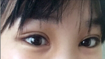 南昌第一附属医院文辉才医生手术果怎么样？