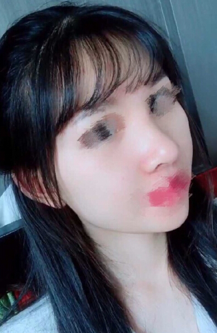 在重庆张劲医生那里做的鼻部手术手术