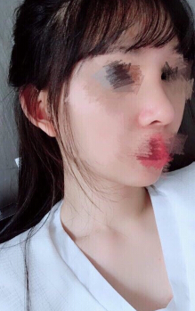 在重庆张劲医生那里做的鼻部手术手术