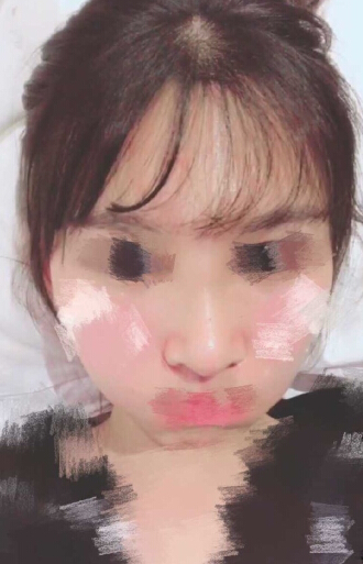 在重庆张劲医生那里做的鼻部手术手术