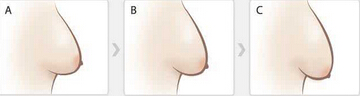 乳房下垂用什么方式改良