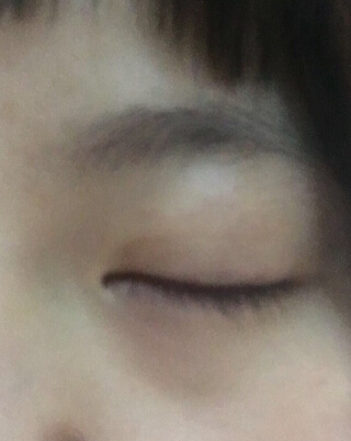 成都艺星刘晓荣院长手术果怎么样？
