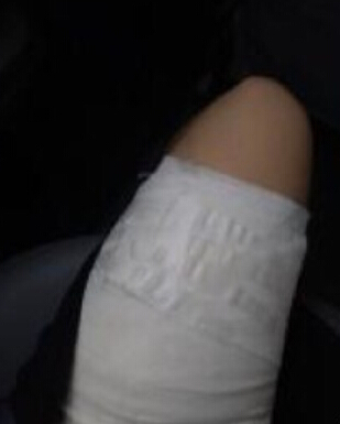 刚做了脂肪填充苹果肌,周一上班,来得及么?