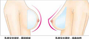 假体隆胸后还能正常哺乳吗?