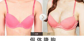 假体隆胸真的靠谱吗?