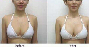哪种丰胸方法见比较快?