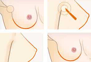 副乳切除术限制年龄的吗