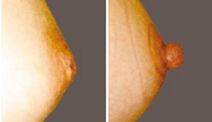 乳头内陷如何矫正,妈妈如何顺利哺乳