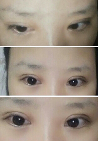 感觉自己肉条明X,双眼皮很宽很假