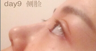 湖北中爱祁向峰教授做的微创双眼皮手术