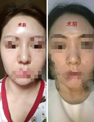 成都医美整形医院刘国权医生鼻部手术整形案例