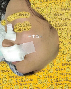 上海九院袁捷医生做的鼻部手术手术案例