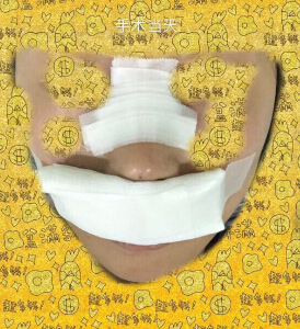 上海九院袁捷医生做的鼻部手术手术案例