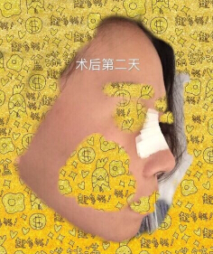 上海九院袁捷医生做的鼻部手术手术案例