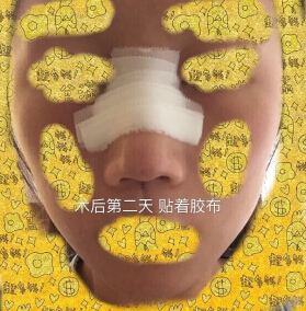 上海九院袁捷医生做的鼻部手术手术案例