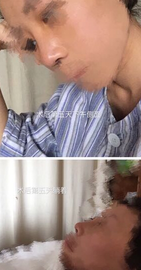 上海九院袁捷医生做的鼻部手术手术案例