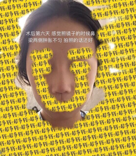上海九院袁捷医生做的鼻部手术手术案例