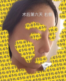上海九院袁捷医生做的鼻部手术手术案例