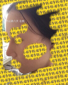 上海九院袁捷医生做的鼻部手术手术案例