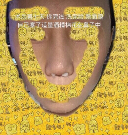 上海九院袁捷医生做的鼻部手术手术案例