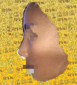 上海九院袁捷医生做的鼻部手术手术案例
