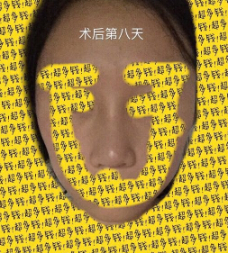 上海九院袁捷医生做的鼻部手术手术案例