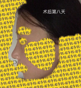 上海九院袁捷医生做的鼻部手术手术案例