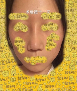 上海九院袁捷医生做的鼻部手术手术案例