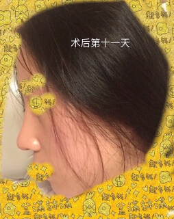 上海九院袁捷医生做的鼻部手术手术案例