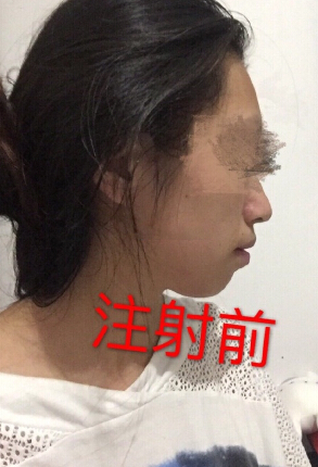 上海九院注射下巴术后果反馈