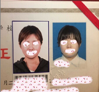 上海九院做的面部吸脂和鼻部手术整形手术