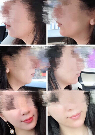 注射舒颜玻尿酸垫下巴术后果