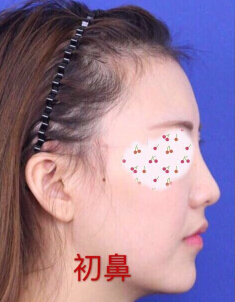 鼻子失败了,劝大家多看案例,不要冲动